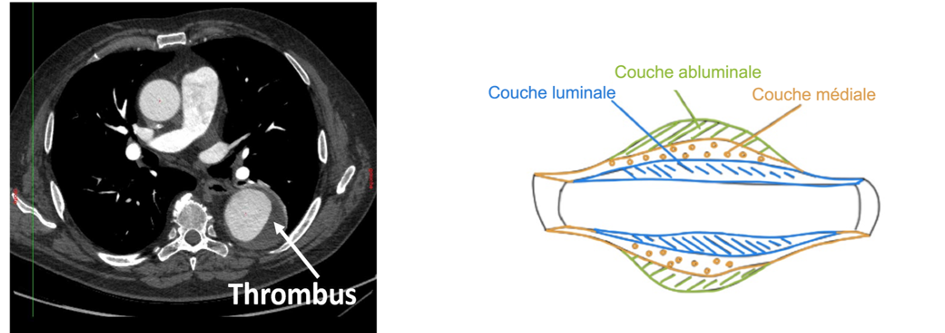 Thrombus-intraluminal